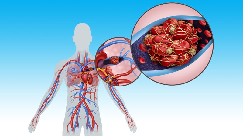 ILD Linked to Worse Outcomes in Pulmonary Embolism