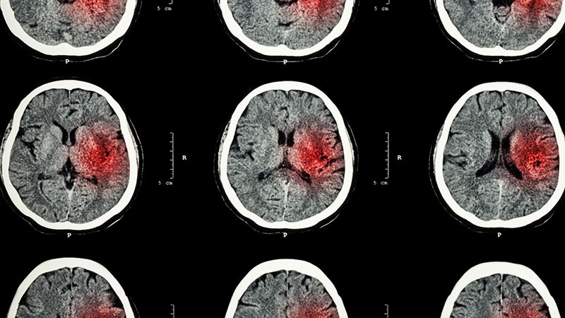 Time to Retire TPA in Acute Ischemic Stroke?